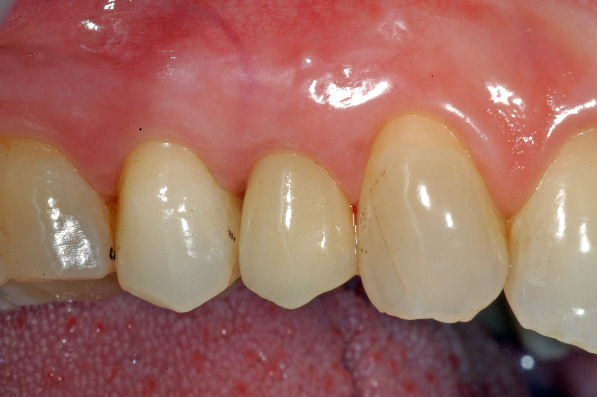 a-dopo-corona-sostenuta-da-un-impianto-dentale-dopo-la-sua-applicazione